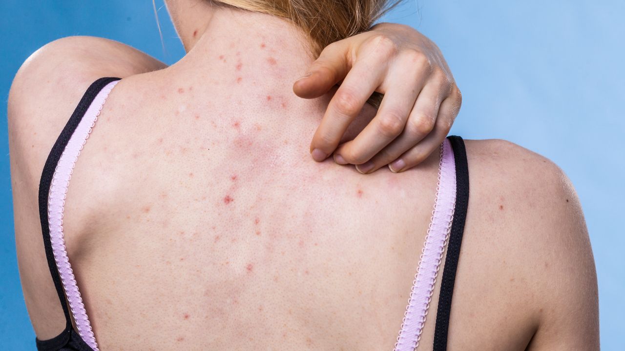 akné a vyrážky na chrbte